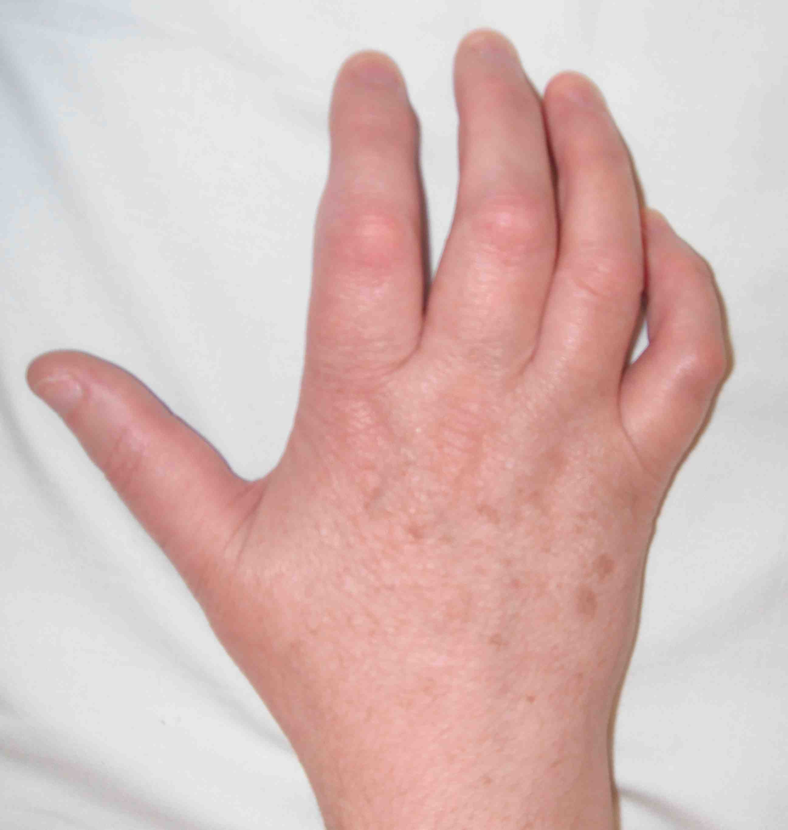 CRPS Hand 2